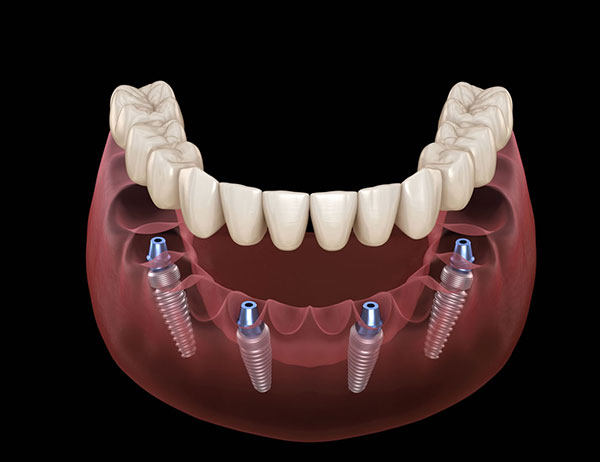 structure of all on Four Dental Implants
