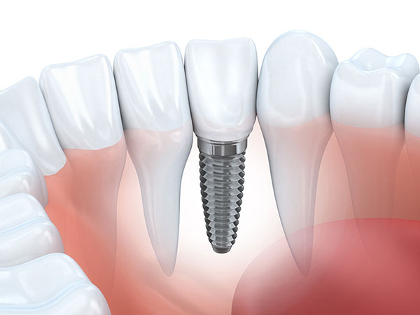 Structure of Implant Single Implant