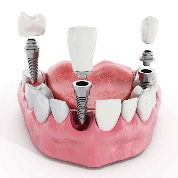 dental implants fitting process structure